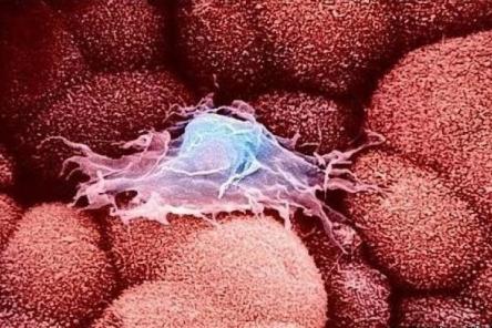 6 полезных привычек, которые помогут предотвратить рак